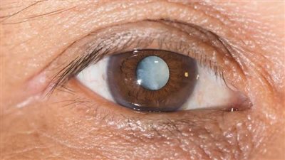 9 عوامل تزيد من الإصابة بمرض المياه البيضاء بالعين