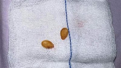 بنها الجامعي تنقذ حياة طفل ابتلع قشرة لب استقرت في القصبة الهوائية 