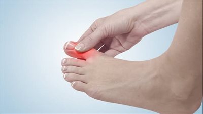 أعراض مرض النقرس