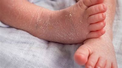 أعراض مرض السماك وطرق علاجه 