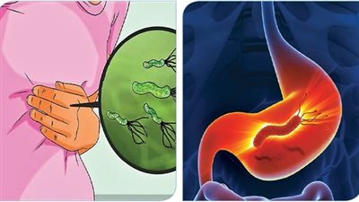 أعراض الميكروب الحلزوني، أسبابه وأفضل طرق العلاج