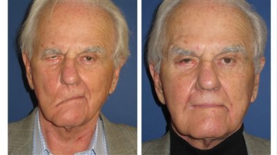 أعراض العصب السابع، والتعرف على أسبابه وطرق العلاج