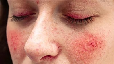 مضاعفات وأعراض الذئبة الحمامية، وكيف تؤثر على الأطفال؟