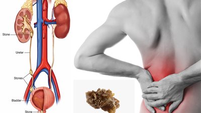  أهمها ترطيب الجسم، طرق الوقاية من الإصابة بحصوات الكلي