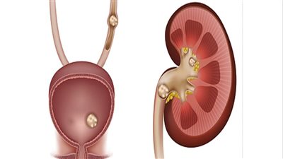 أعراض حصوات الكلى وأسبابها وطرق العلاج والوقاية