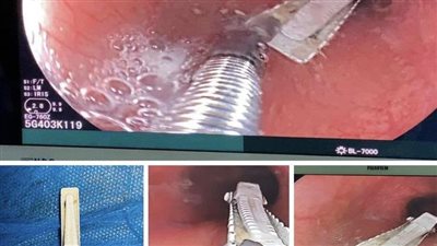 استخراج توكة شعر من معدة صبي عراقي (صور)