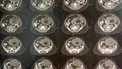 الصدفة تقود لاستئصال ورم سرطانى وزنه ٨ كيلو جرامات بالمنصورة 