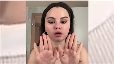  بعد فيديو سيلينا جوميز، كل ما تريد معرفته عن مرض الذئبة