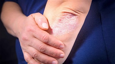 أعراض نقص الزنك.. وأفضل طرق العلاج من الطبيعة