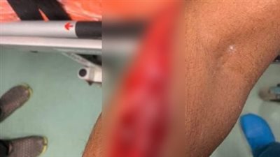 تهتك بالذراع.. سمكة قرش تهاجم شخصا يسبح في الساحل الشمالي