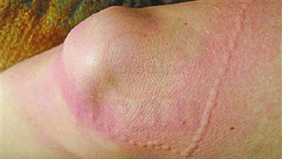 علاج لسعة القنديل.. وطرق الوقاية منها