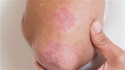 8 نصائح بسيطة لتقليل أعراض الصدفية من المنزل