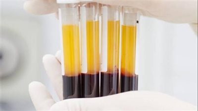 متى يمكن تكرار التبرع بالبلازما؟ الصحة تجيب