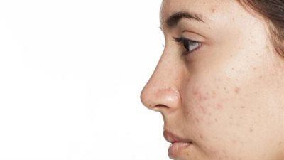 وصفات طبيعية للتخلص من حبوب الوجه 