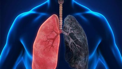 الصحة: هؤلاء معرضون للإصابة بأورام الرئة