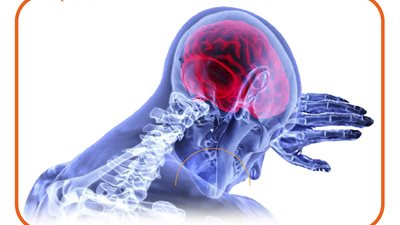 7 أعراض مؤشر لحدوث نزيف في المخ 