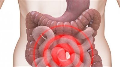 أعراض القولون العصبي، وأسبابه وأطعمة تخفف من أعراضه