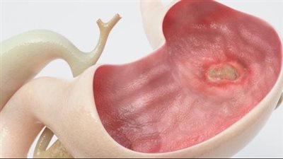 أعراض قرحة المعدة، أبرزها حرقان المعدة وفقدان الشهية والوزن