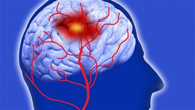 أهم أعراض ارتفاع ضغط المخ 