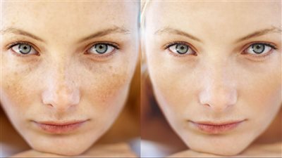 علاج النمش في الوجه بوصفات طبيعية وفي أسرع وقت