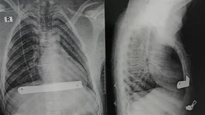 بنها الجامعي تنقذ مريضا يعاني من تحدب في عظمة القفص الصدري 
