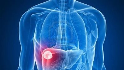 علاج الكبد الدهني، وأعراضه وطرق الوقاية