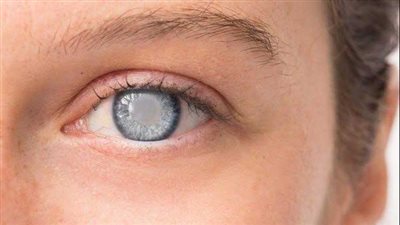 أعراض مرض المياه البيضاء وأهم أسبابه 