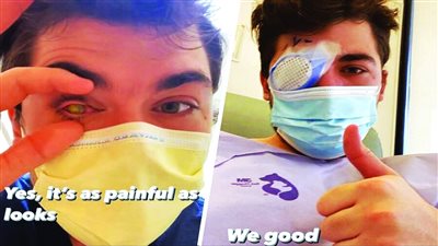 أمريكي يصاب بالعمى بعد النوم بعدسة لاصقة