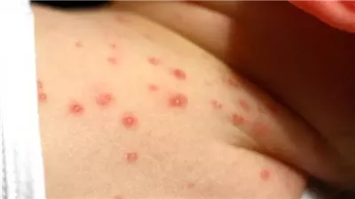 علاج الجدري المائي وأعراض الإصابة وطرق العدوى 