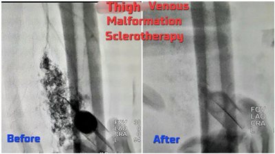مستشفى سوهاج الجامعي تجري أول قسطرة متقدمة بوحدة الأشعة التداخلية 