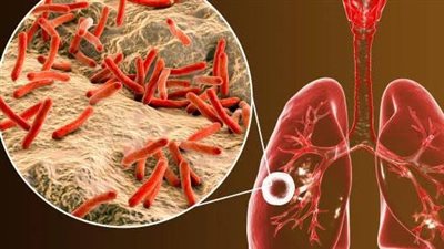 تطوير عقار جديد يعالج الدرن في شهرين فقط