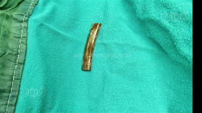 استخراج جسم معدني استقر أسفل الأحبال الصوتية من مريض بالمنوفية