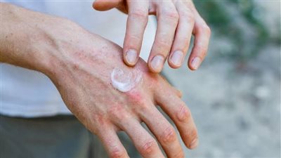 مرض التقرن الشمسي، أعراض لو ظهرت عليك يجب زيارة الطبيب فورًا(فيديو)