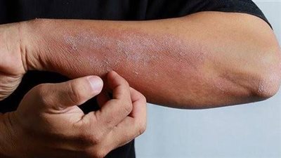 أسباب تواجد أمراض البكتيريا في الغدد الدهنية (فيديو)