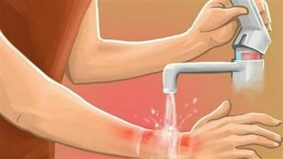 6 إسعافات أولية يجب اتباعها في حالات الحروق