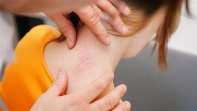 مرض الصدفية، أسبابه وأعراضه وأنواعه وطرق العلاج 