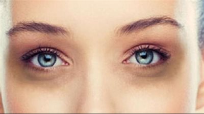 وصفة طبيعية لتخفيف الهالات السوداء وشد منطقة حول العين