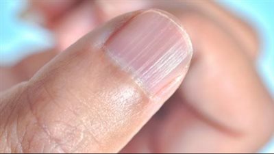 أعراض نقص الزنك، الأنيميا وضعف المناعة وتساقط الشعر وتشققات الجلد 