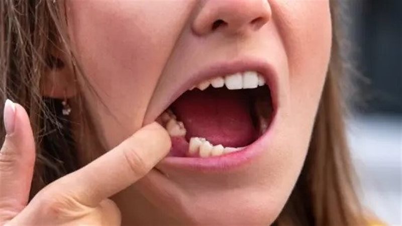 تفسير حلم خلع الضرس