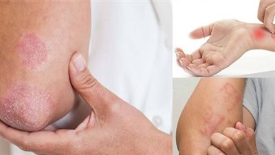 أغرب الأمراض الجلدية في مصر، الحك الإشعاعي وظهور بقع غريبة في الجسم (فيديو)