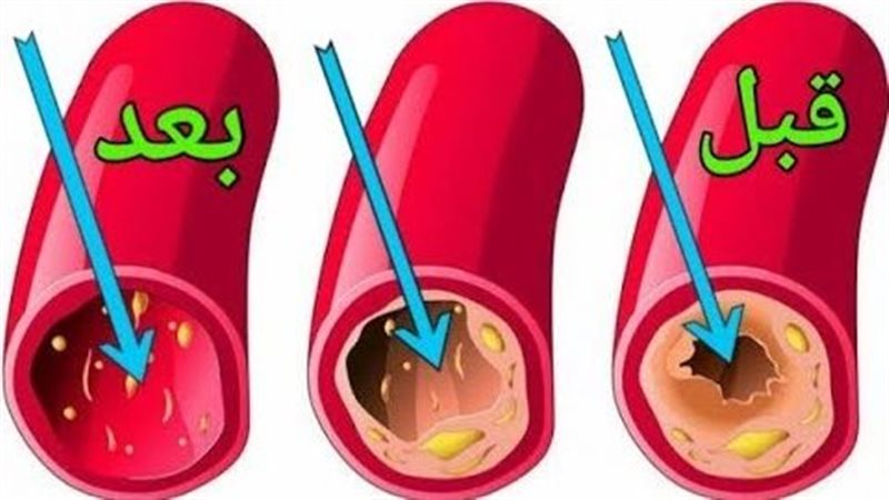 تنظيف الشرايين من