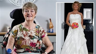 امرأة بدون يدين ترفض زراعة أيدٍ لشخص أسود