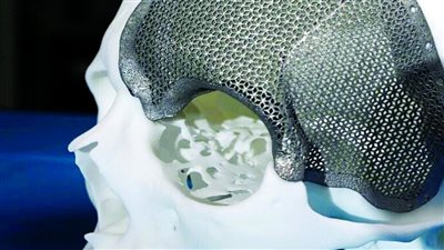 ابتكار أطراف اصطناعية من ألياف الكربون