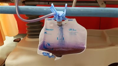 حالة نادرة، مرض يحول لون البول إلى أرجواني، وأطباء يكشفون مدى خطورته