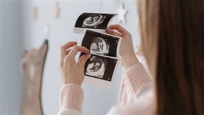 استقر في بطنها 9 سنوات، جنين متحجر ينهي حياة والدته