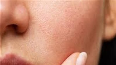 وصفة طبيعية لصفاء البشرة والتخلص من المسام الواسعة 