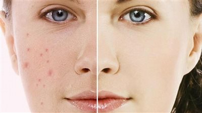 علاج حب الشباب بالوصفات الطبيعية، أبرزها الكركم والعسل 