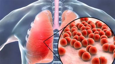 اليوم العالمي للسل، الأعراض والأسباب وطرق الوقاية