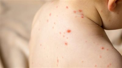 هاني الناظر يحذر من انتشار مرض الجديري بين الأطفال بسبب التقلبات الجوية