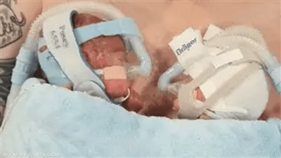 حالة نادرة، ولادة طفلين في الشهر السادس 